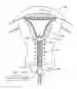 Fig. 01 - Systems and methods for endometrial ablation