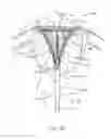 Fig. 11 - Systems and methods for endometrial ablation