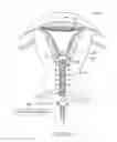 Fig. 28 - Systems and methods for endometrial ablation