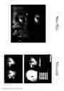 Fig. 12 - Method and system for trackerless image guided soft tissue surgery and applications of same