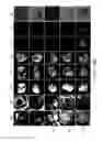 Fig. 16 - Method and system for trackerless image guided soft tissue surgery and applications of same