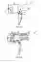 Fig. 31 - Techniques and instruments for placement of orthopedic implants relative to bone features