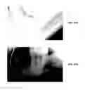 Fig. 41 - ENDODONTIC INSTRUMENTS AND ROOT CANAL TREATMENT METHODS