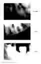 Fig. 44 - ENDODONTIC INSTRUMENTS AND ROOT CANAL TREATMENT METHODS