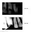 Fig. 46 - ENDODONTIC INSTRUMENTS AND ROOT CANAL TREATMENT METHODS