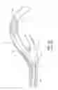 Fig. 09 - Retrieval catheter