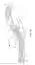 Fig. 12 - Retrieval catheter