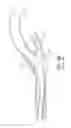 Fig. 15 - Retrieval catheter