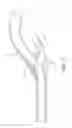 Fig. 17 - Retrieval catheter