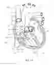 Fig. 02 - DEVICES AND METHODS FOR REDUCING CARDIAC VALVE REGURGITATION