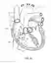 Fig. 04 - DEVICES AND METHODS FOR REDUCING CARDIAC VALVE REGURGITATION