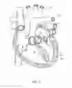 Fig. 07 - DEVICES AND METHODS FOR REDUCING CARDIAC VALVE REGURGITATION