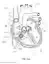 Fig. 13 - DEVICES AND METHODS FOR REDUCING CARDIAC VALVE REGURGITATION