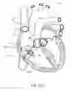 Fig. 15 - DEVICES AND METHODS FOR REDUCING CARDIAC VALVE REGURGITATION