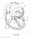 Fig. 18 - DEVICES AND METHODS FOR REDUCING CARDIAC VALVE REGURGITATION