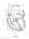 Fig. 25 - DEVICES AND METHODS FOR REDUCING CARDIAC VALVE REGURGITATION