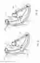 Fig. 41 - DEVICES AND METHODS FOR REDUCING CARDIAC VALVE REGURGITATION