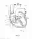 Fig. 44 - DEVICES AND METHODS FOR REDUCING CARDIAC VALVE REGURGITATION