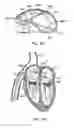 Fig. 05 - Prosthetic heart valve devices and associated systems and methods