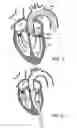 Fig. 07 - Prosthetic heart valve devices and associated systems and methods
