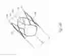 Fig. 06 - PERCUTANEOUS HEART VALVE, SYSTEM, AND METHOD