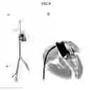 Fig. 05 - Valve prosthesis