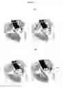 Fig. 11 - Valve prosthesis