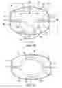 Fig. 03 - Mitral bileaflet valve