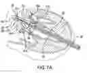 Fig. 14 - Mitral bileaflet valve