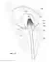 Fig. 03 - Mitral valve inversion prostheses