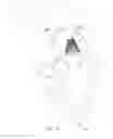 Fig. 12 - Mitral valve inversion prostheses
