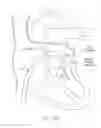 Fig. 23 - Mitral valve inversion prostheses
