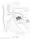 Fig. 24 - Mitral valve inversion prostheses