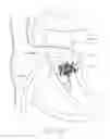 Fig. 25 - Mitral valve inversion prostheses