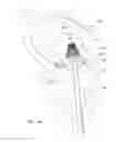 Fig. 03 - Mitral valve inversion prostheses