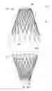 Fig. 10 - Mitral valve inversion prostheses