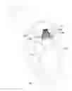 Fig. 14 - Mitral valve inversion prostheses