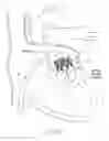 Fig. 24 - Mitral valve inversion prostheses