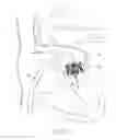 Fig. 25 - Mitral valve inversion prostheses