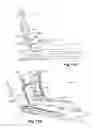 Fig. 07 - Ankle prosthesis