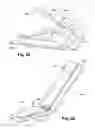 Fig. 14 - Ankle prosthesis