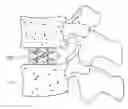 Fig. 01 - Intervertebral implant