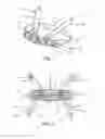 Fig. 02 - Intervertebral implant
