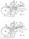 Fig. 04 - Inside-out guide for hip replacement method