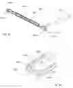 Fig. 32 - Apparatus and method for stabilizing adjacent bone portions
