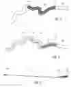 Fig. 04 - Stents twisted prior to deployment and untwisted during deployment