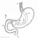 Fig. 01 - Stomach-Spanning Gastric Implants