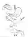 Fig. 02 - Stomach-Spanning Gastric Implants