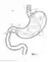 Fig. 03 - Stomach-Spanning Gastric Implants