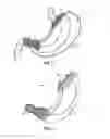 Fig. 04 - Stomach-Spanning Gastric Implants